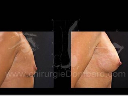 Avant - Après. Vue de profile. Prothèse anatomique rétro-musculaire. 6 mois. Seins Proteses mammaire