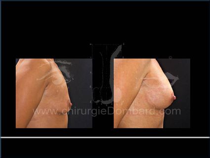 Avant - Après. Vue de profile. Prothèse anatomique rétro-musculaire. 6 mois. Seins Proteses mammaire