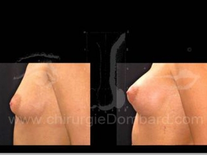 Avant - Après. Prothèses ronde rétro-musculaire. 6 mois. Seins Proteses mammaire