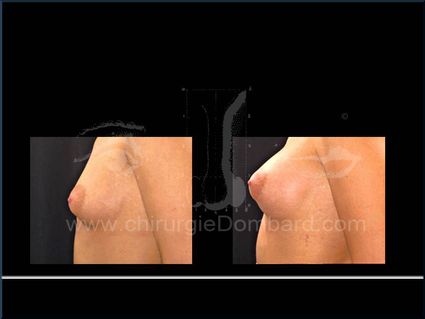Avant - Après. Prothèses ronde rétro-musculaire. 6 mois. Seins Proteses mammaire