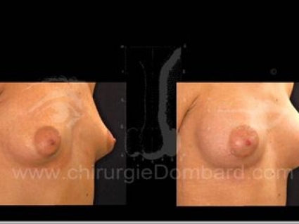 Avant - Après. Prothèses ronde rétro-musculaire. 6 mois. Seins Proteses mammaire