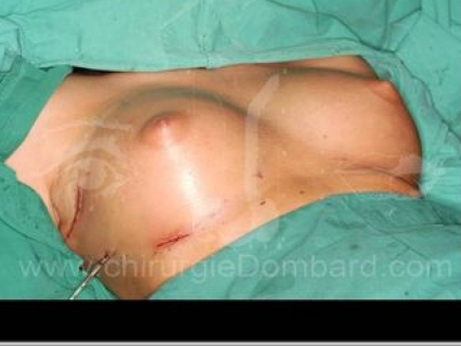 Résultats post-opératoire immédiat. Incision axillaire + Contre-incision au niveau du sillon.