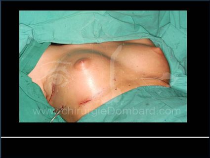 Résultats post-opératoire immédiat. Incision axillaire + Contre-incision au niveau du sillon.