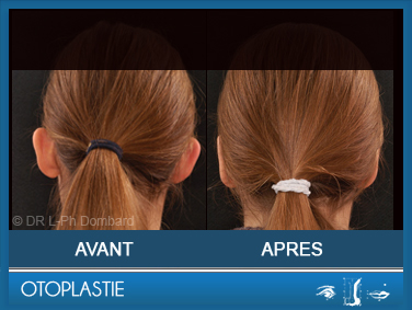 Otoplastie - Correction des oreilles décollées. Vu de dos