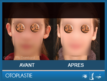 Otoplastie - Correction des oreilles décollées. Vu de face.