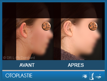 Otoplastie - Correction des oreilles décollées. Vu de profil.