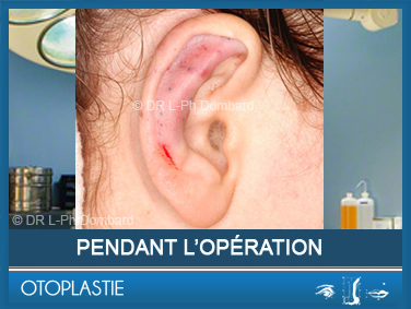Otoplastie - Correction des oreilles décollées. Vu de l'opération.