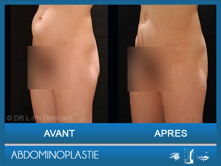 Abdominoplastie