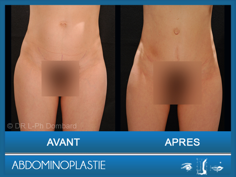 Abdominoplastie