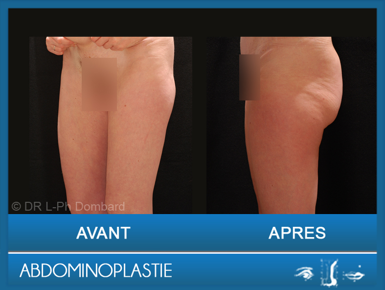 Abdominoplastie