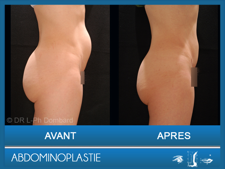 Abdominoplastie