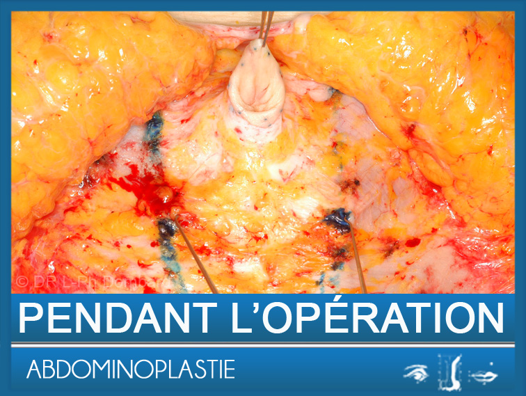 Abdominoplastie