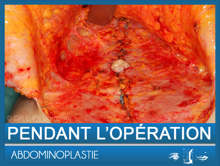 Abdominoplastie