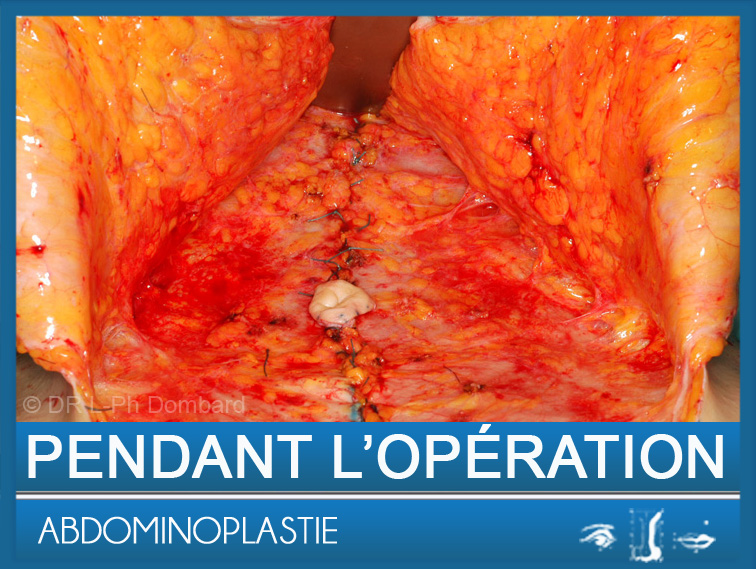 Abdominoplastie