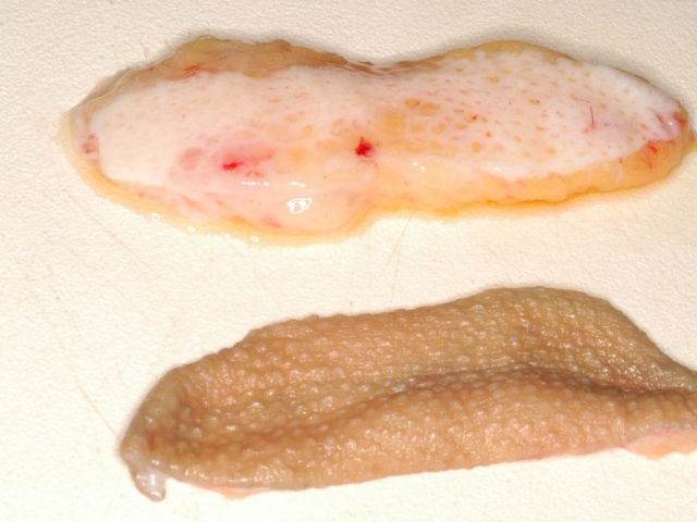 LIPOFILLING