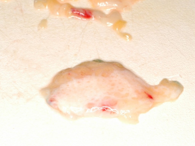 LIPOFILLING