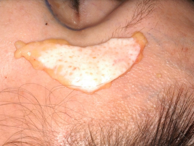 LIPOFILLING