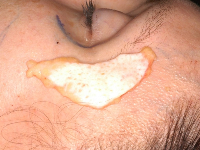 LIPOFILLING