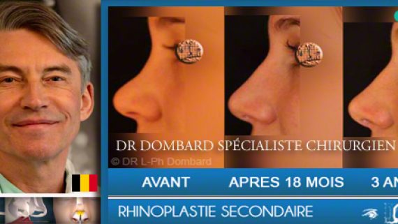 Rhinoplastie par DR Dombard, spécialiste chirurgien esthétique et plastique.