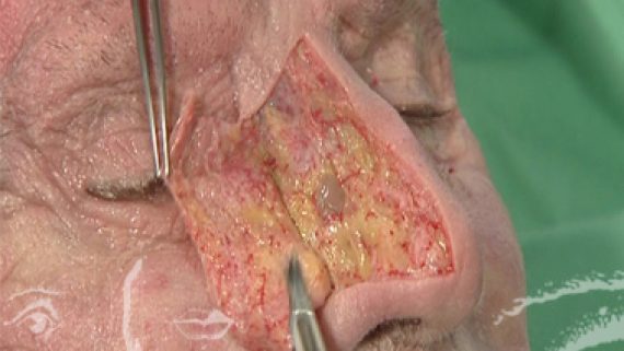 Docteur Dombard préparation Congrès: Rhinoplastie - Anatomie